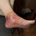 Sprunggelenksfraktur , geschwollen , Bluterguss, SFX Maske , Prosthetics movieSFX Spezialeffekte für Film und TV
